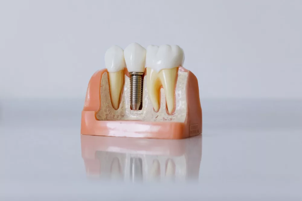 Unveiling the Hollywood Smile: Celebrity Dental Implants Before and After